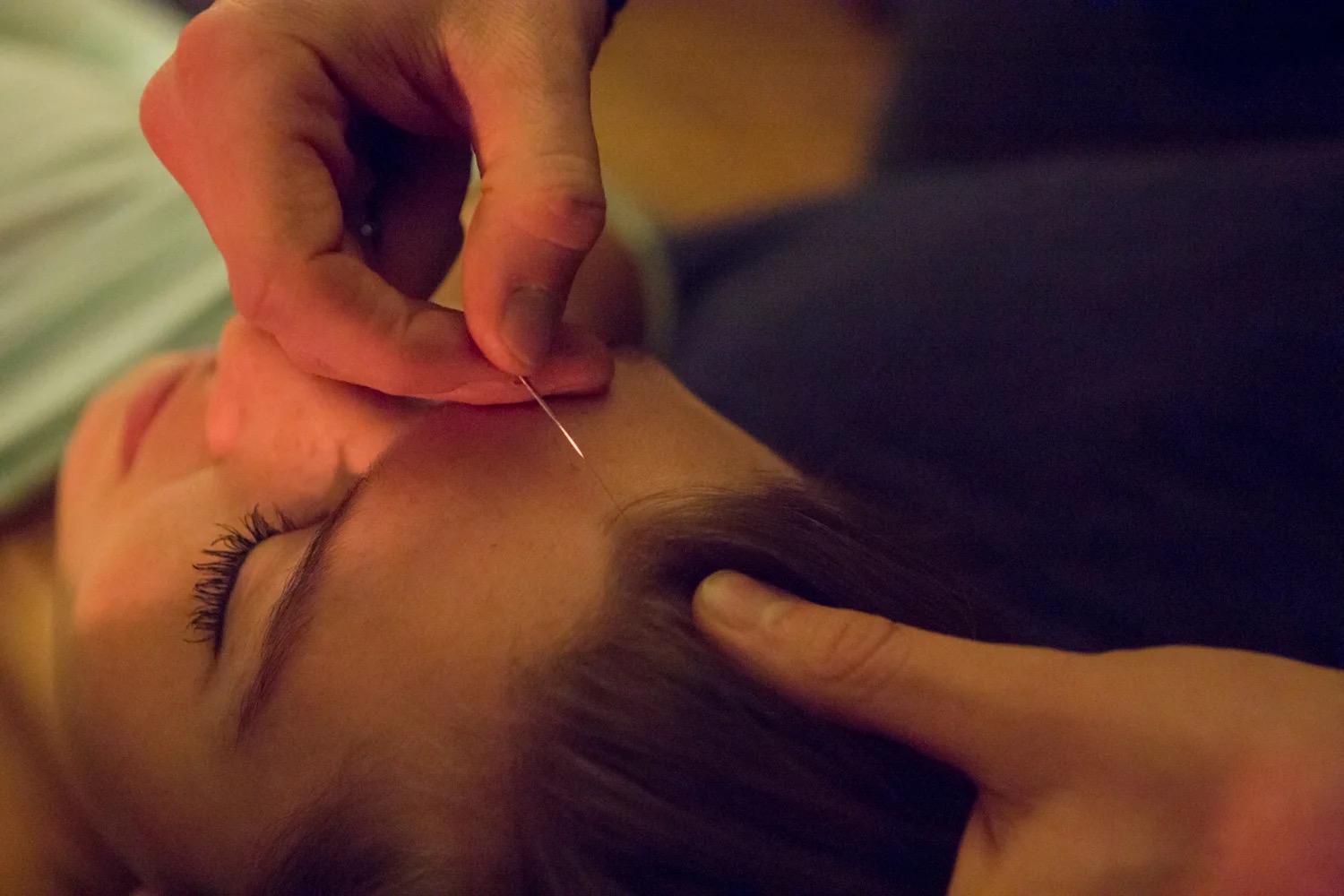 Acupuncture treatment