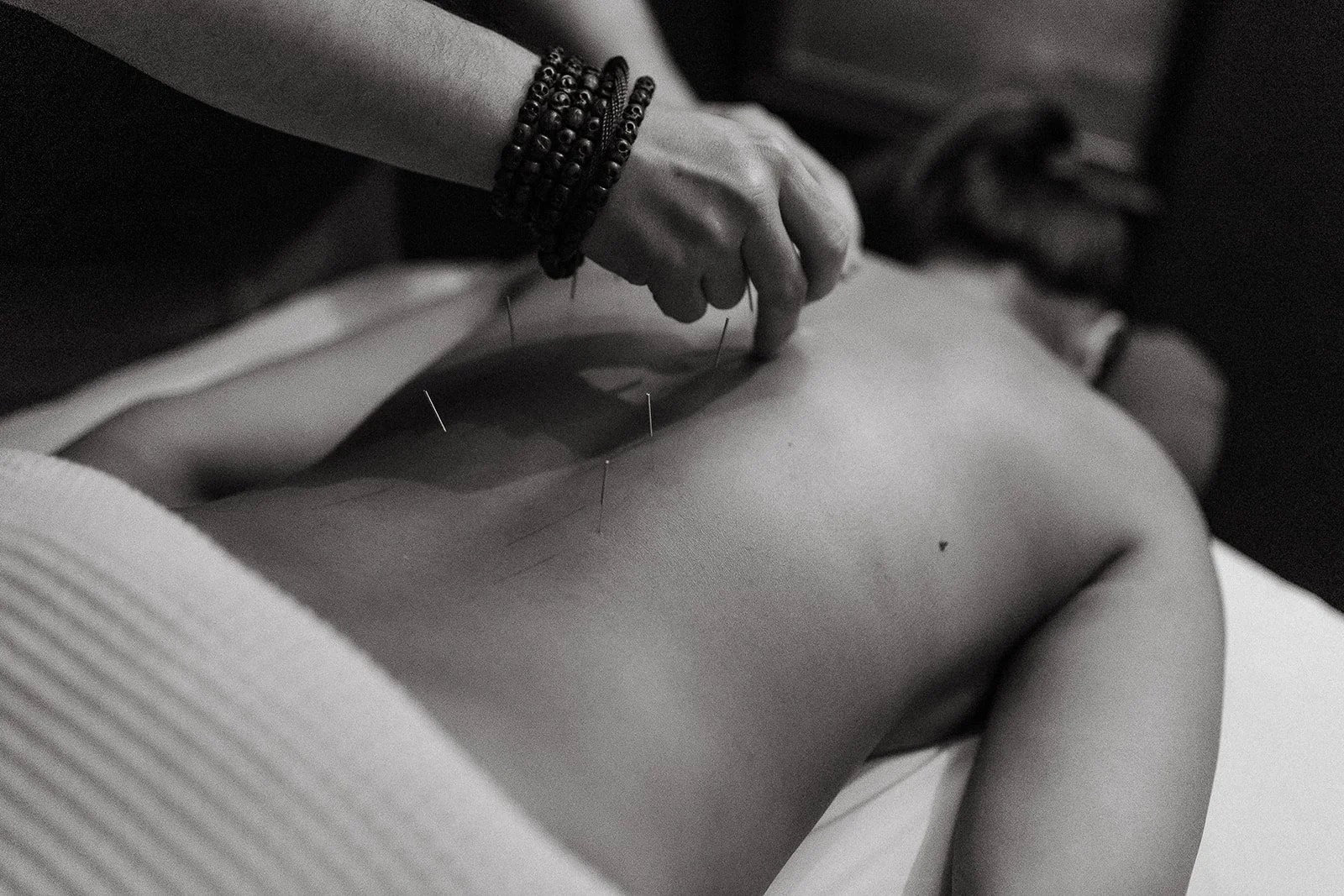Acupuncture